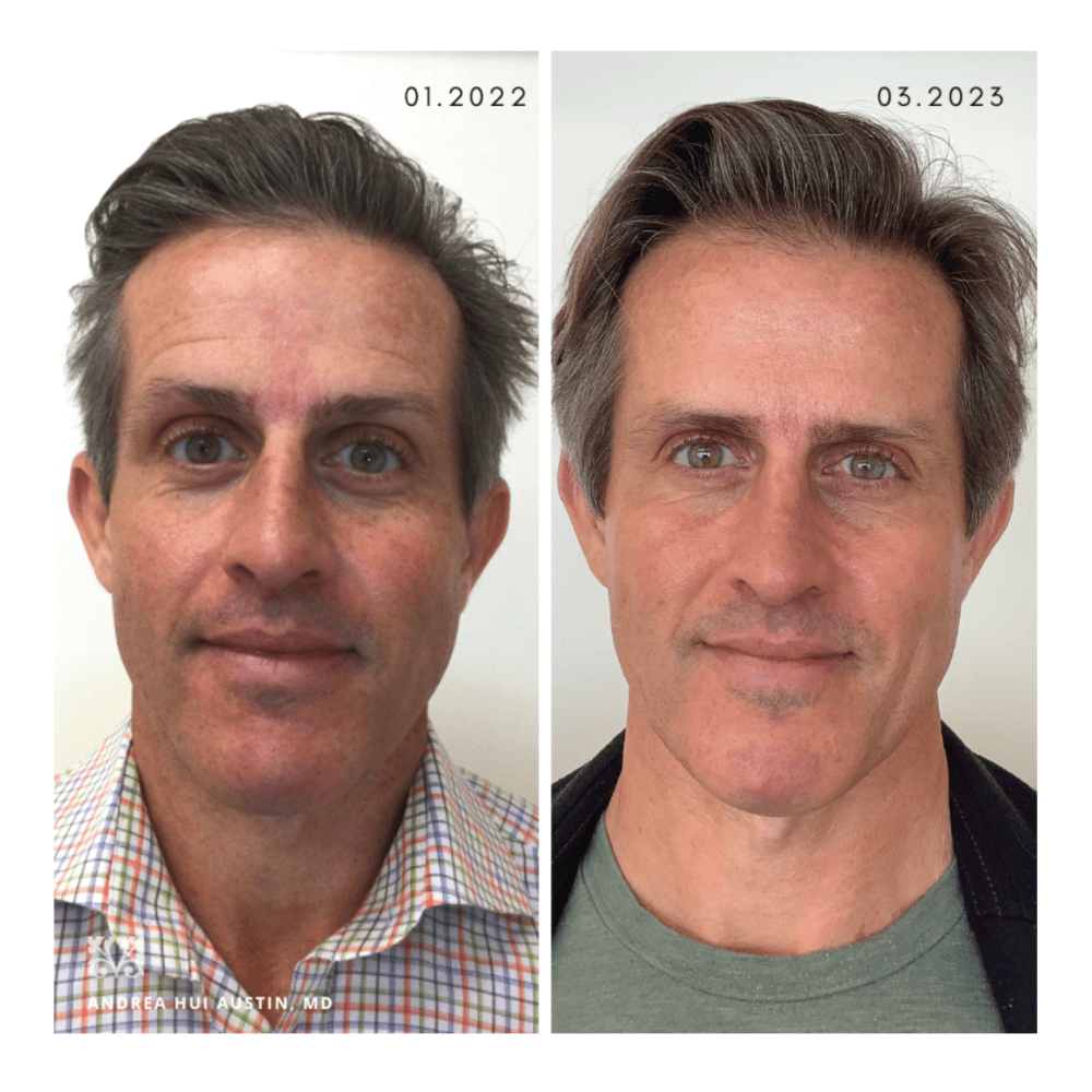 Case Study 1, JDD Before After