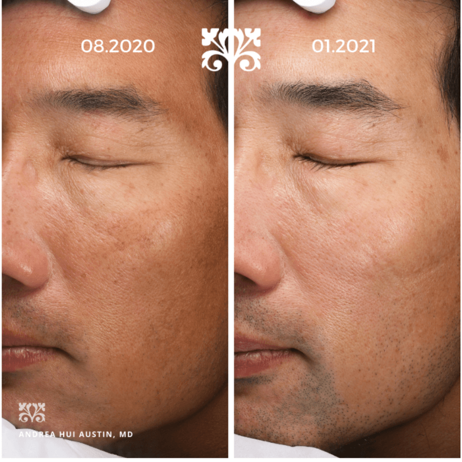 Case Study 3, JDD Before After