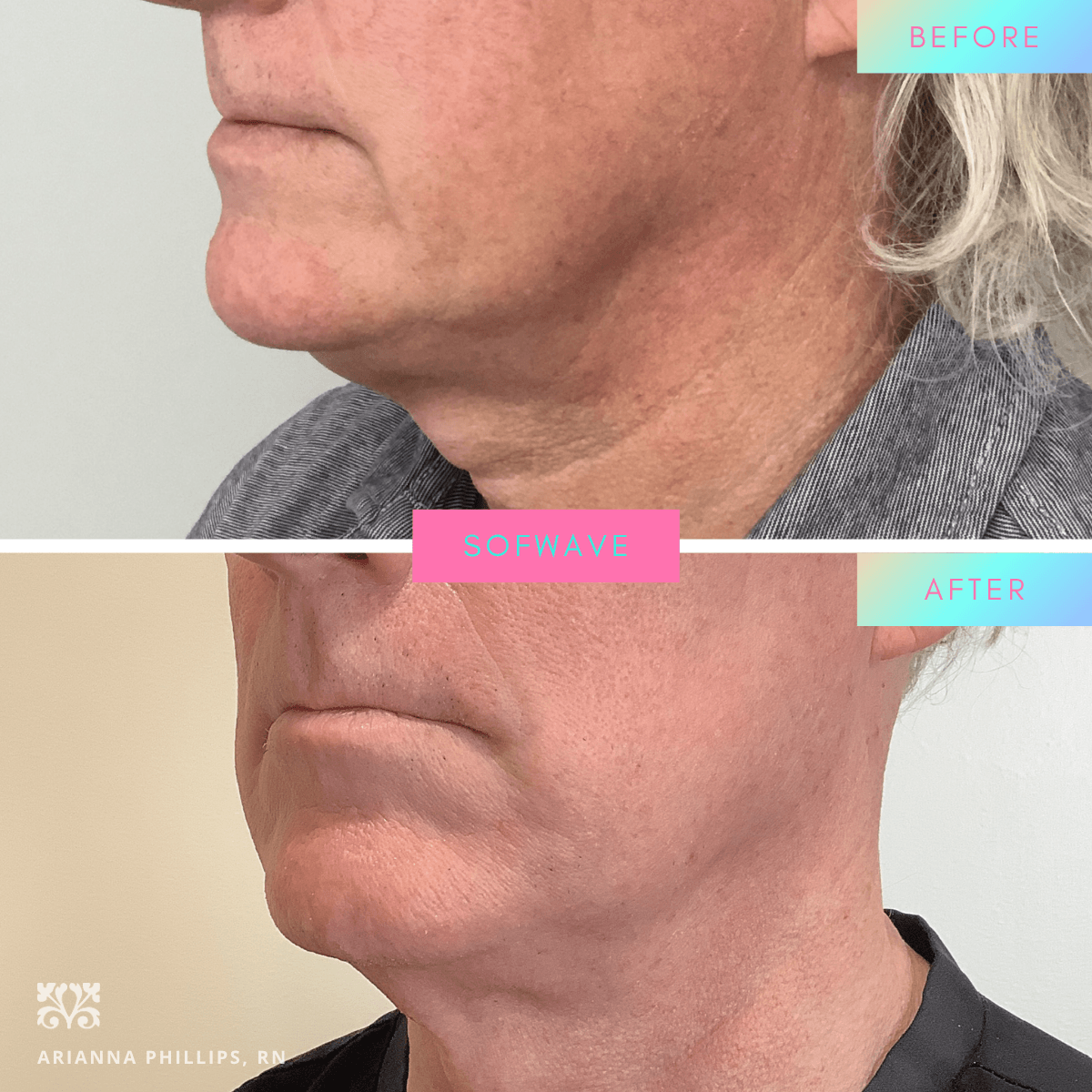 Sofwave before and after