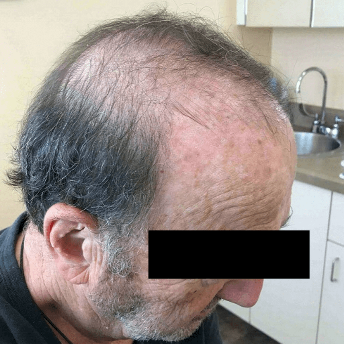 Hair Regrowth Is Possible San Francisco California