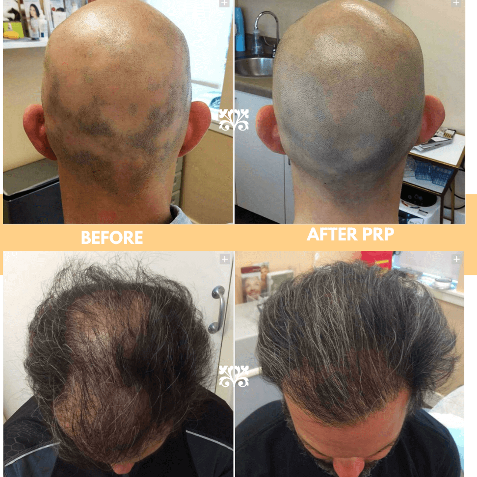 Hair today, gone tomorrow: How We Use PRP to Make Hair GROW again