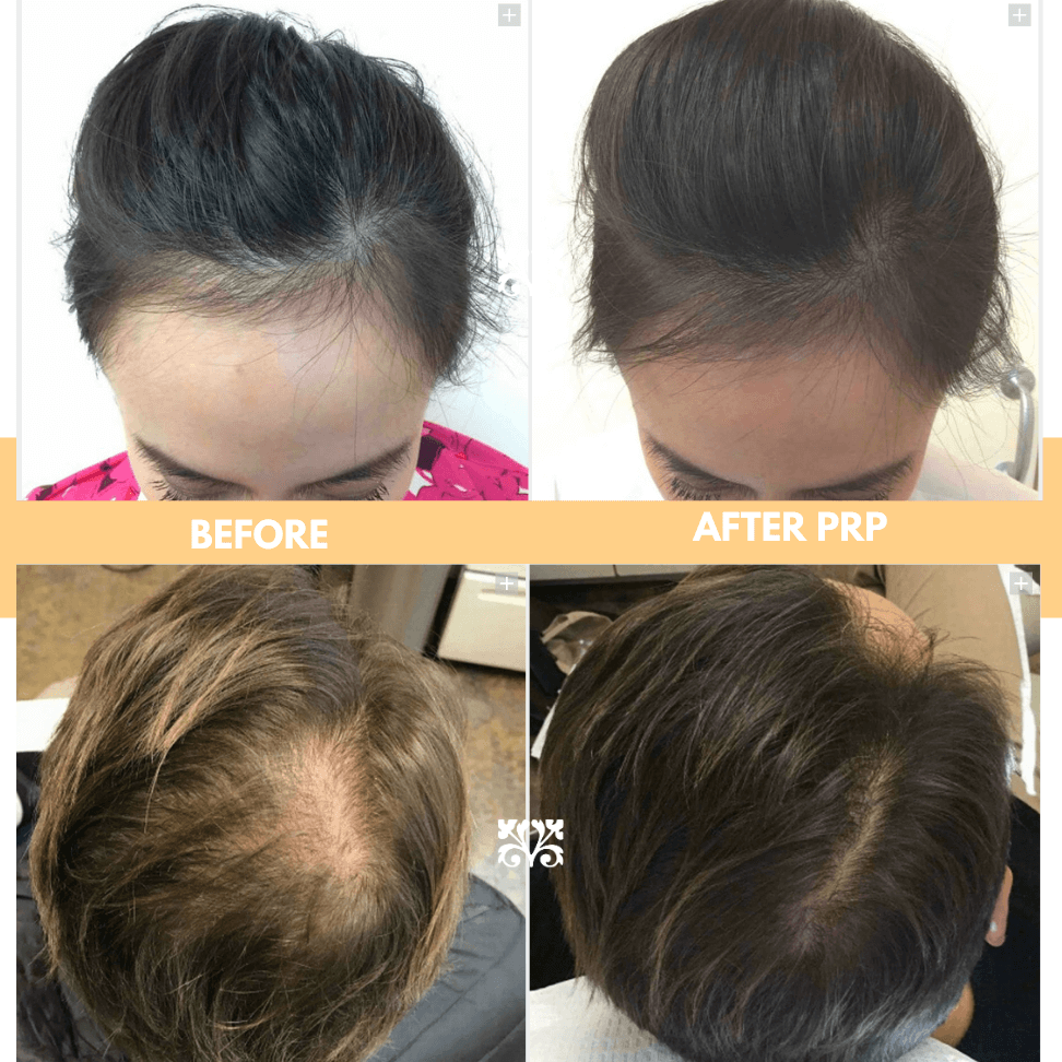 Hair today, gone tomorrow: How We Use PRP to Make Hair GROW again