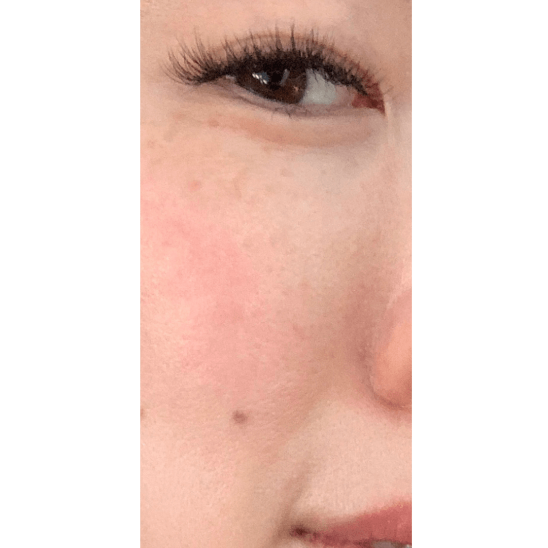 Before and After Nonsurgical Skin Tightening Photos