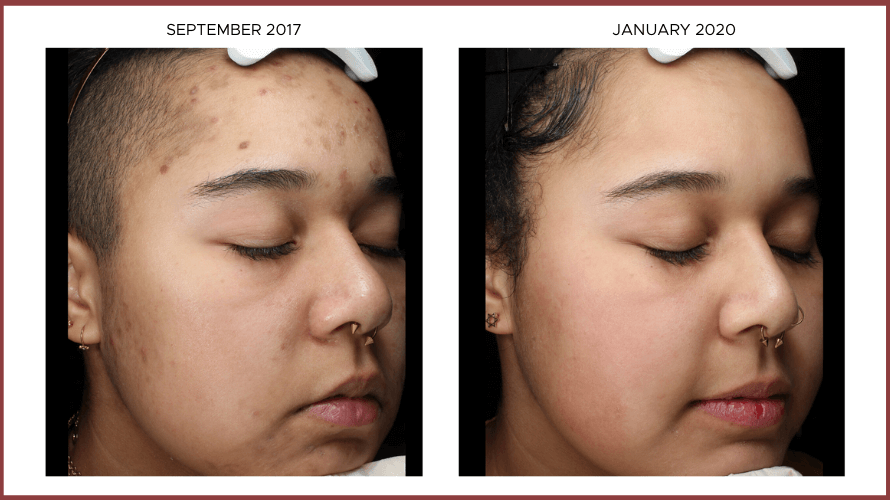 Tranexamic Acid to Prevent and Treat Post-Inflammatory Hyperpigmentation