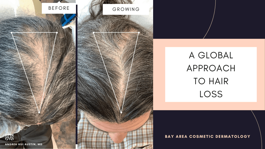 A Approach to Hair Loss: How Oral Can Help Hair