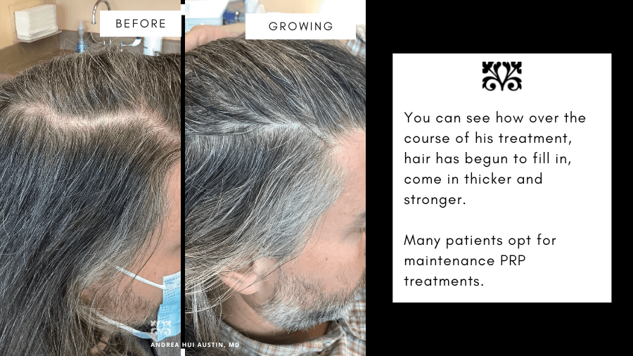 New Test Determines if a Patient Will Respond to Oral Minoxidil   MedEsthetics