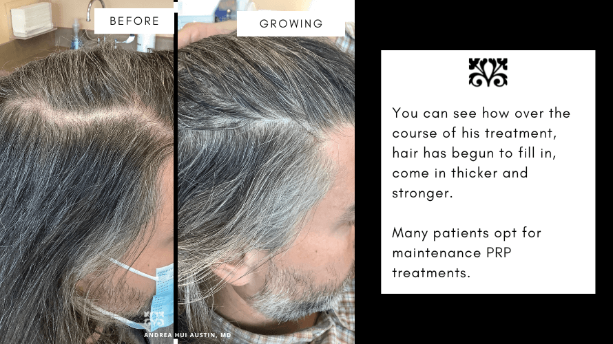 A Global Approach to Hair Loss: How Oral Minoxidil Can Help Regrow Hair